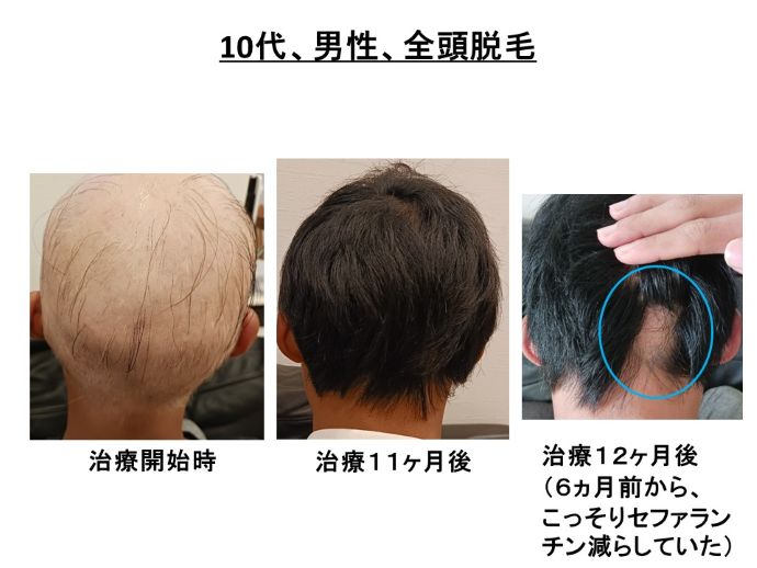 円形脱毛症　病院